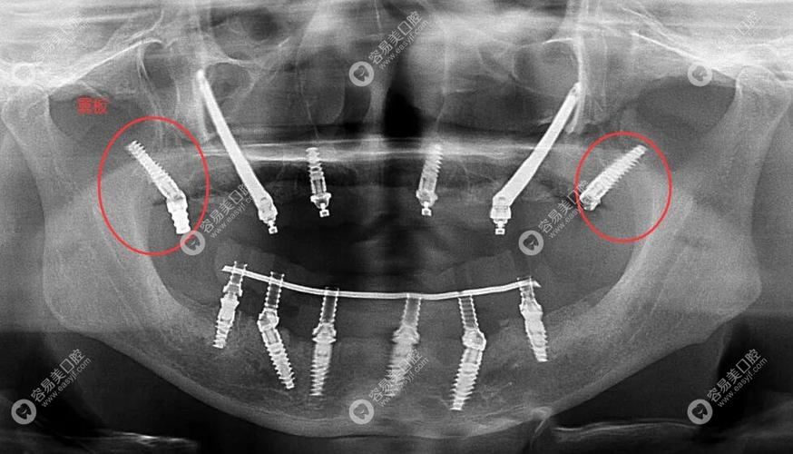植牙可以植在颧骨上吗-图2