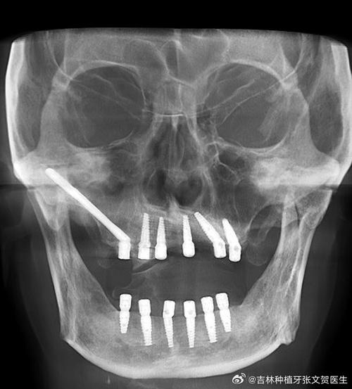 植牙可以植在颧骨上吗-图3