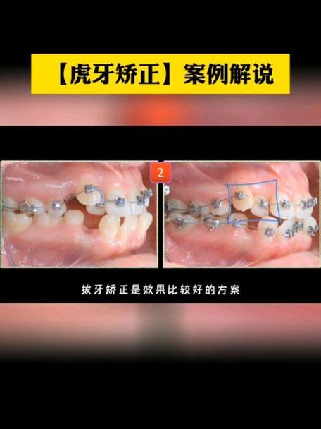 虎牙是乳牙怎么正畸-图2 虎牙是乳牙怎么正畸-图2