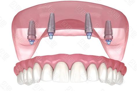 allon4种植牙-图2