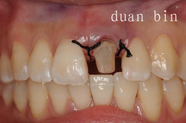 松牙翻瓣植骨后为何会痛？-图2