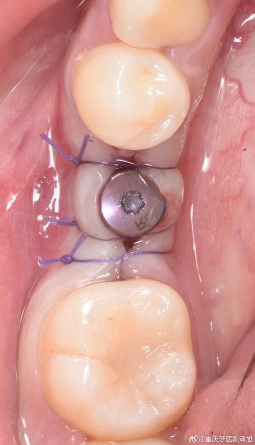 植牙装基台会痛吗-图2
