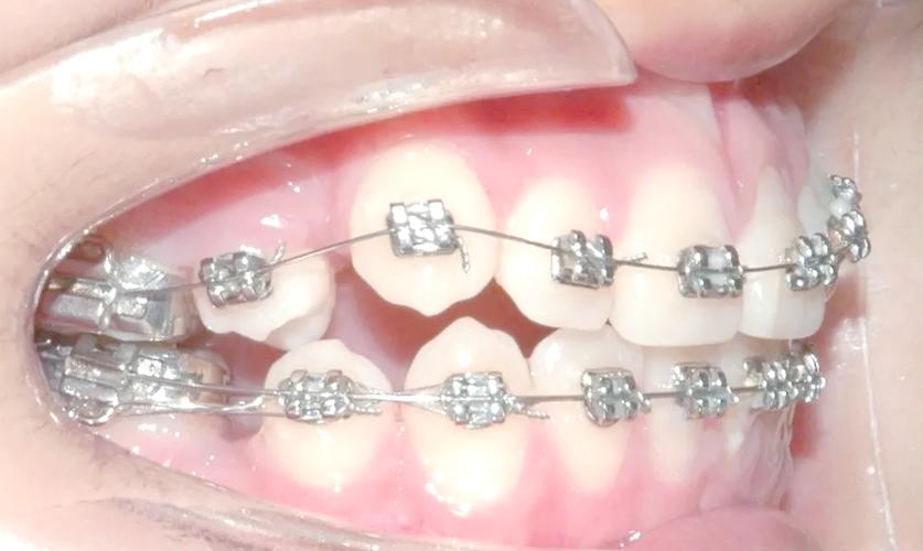 正畸托槽需要调整吗-图1 正畸托槽需要调整吗-图1