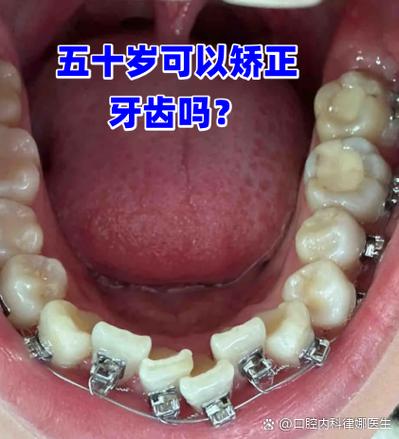 正畸托槽需要调整吗-图3 正畸托槽需要调整吗-图3