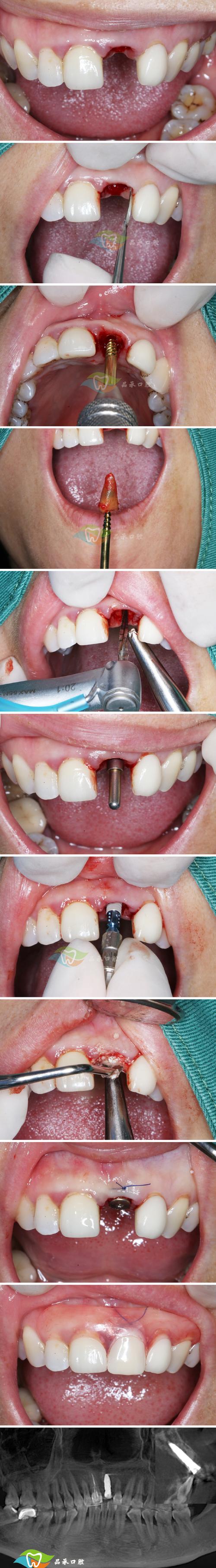 植牙中的即拔即种-图2