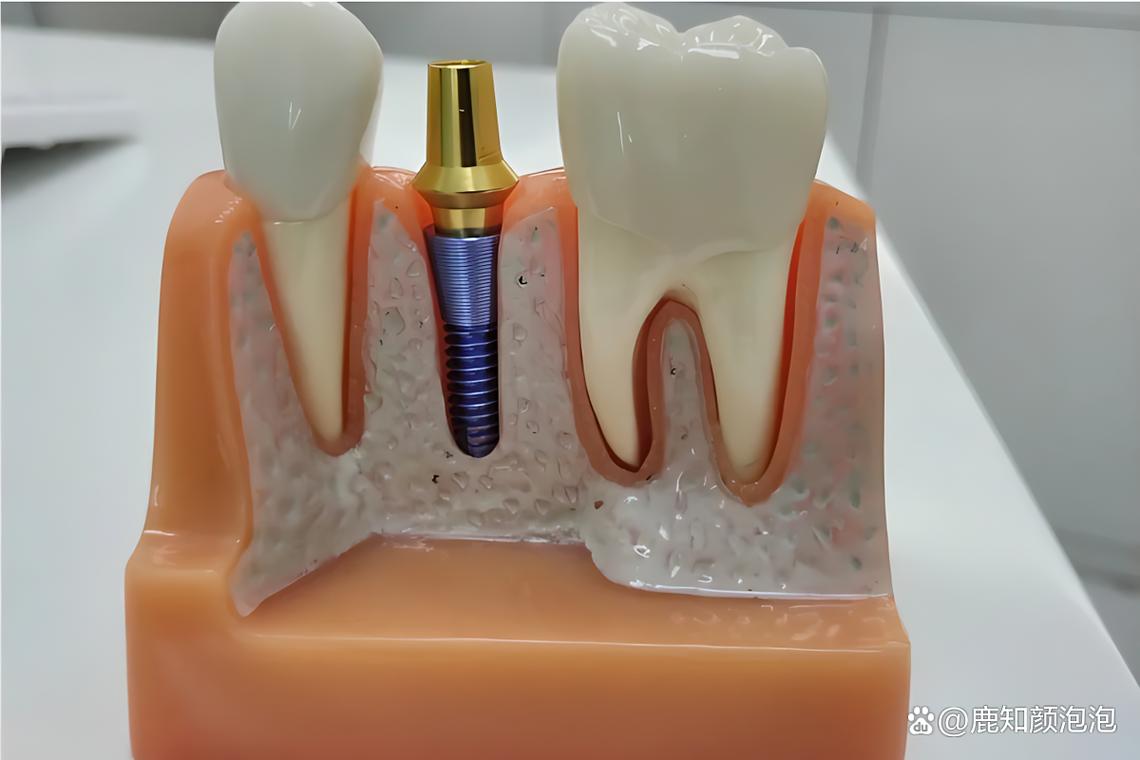 德伦植牙费用多少？价格受哪些因素影响？-图2