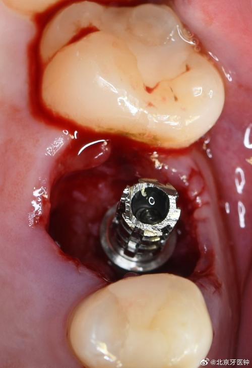 植体邻牙有牙髓炎-图1