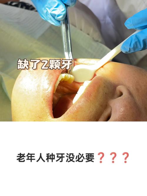 老年人植牙的坏处-图2 老年人植牙的坏处-图2