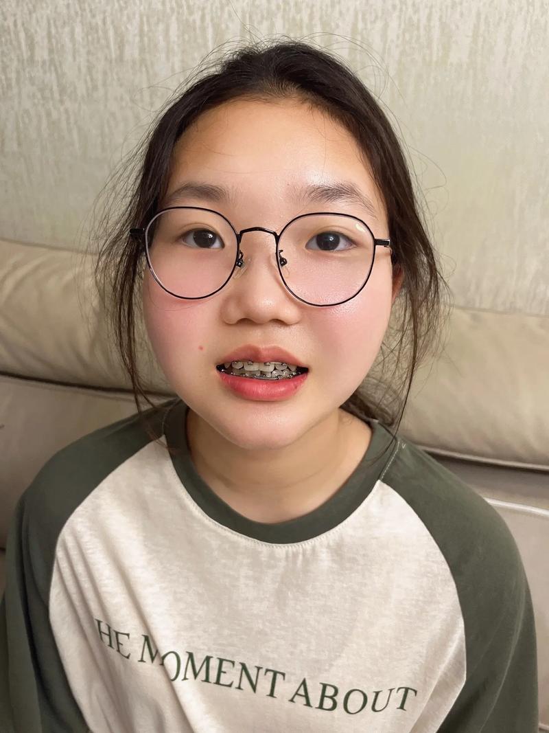 正畸 直丝弓 图片-图2