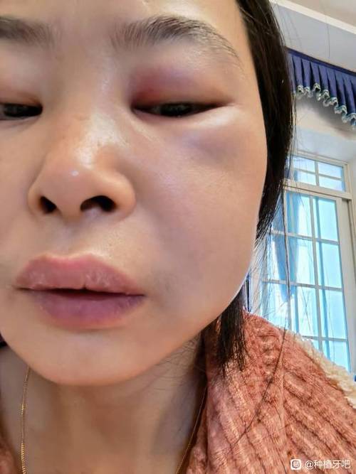 种牙植骨要肿多久-图1