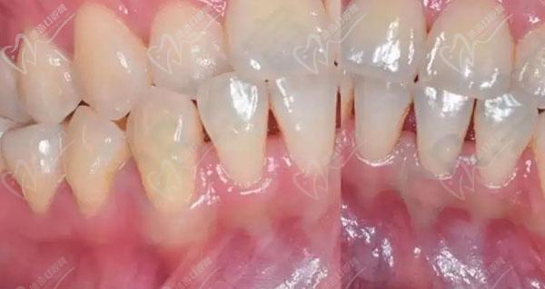 牙槽骨薄正畸植骨-图3