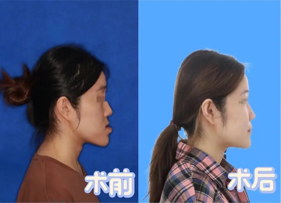 正畸 安氏三 案例-图2