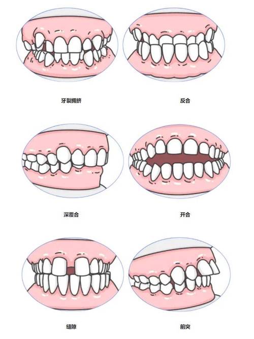 正畸牙齿移动的范围-图1