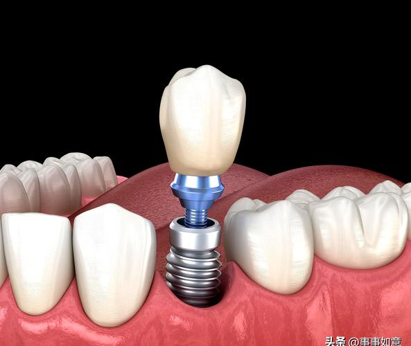 新疆種植牙好不好-图2