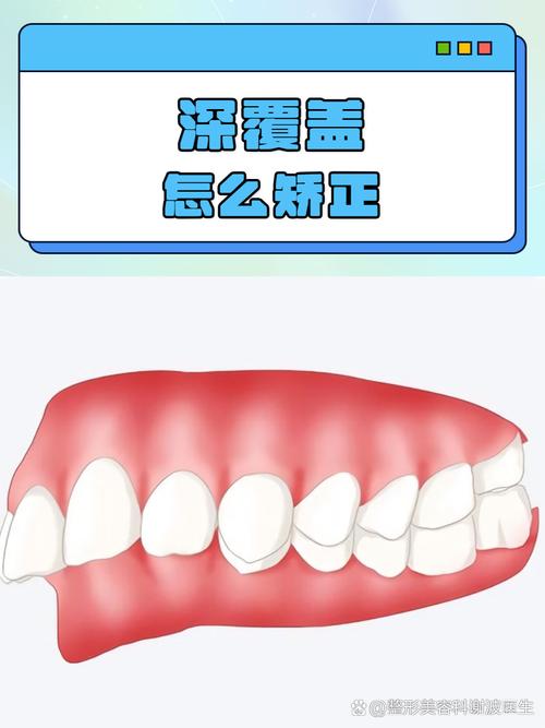 口腔正畸中覆盖具体指什么？-图1