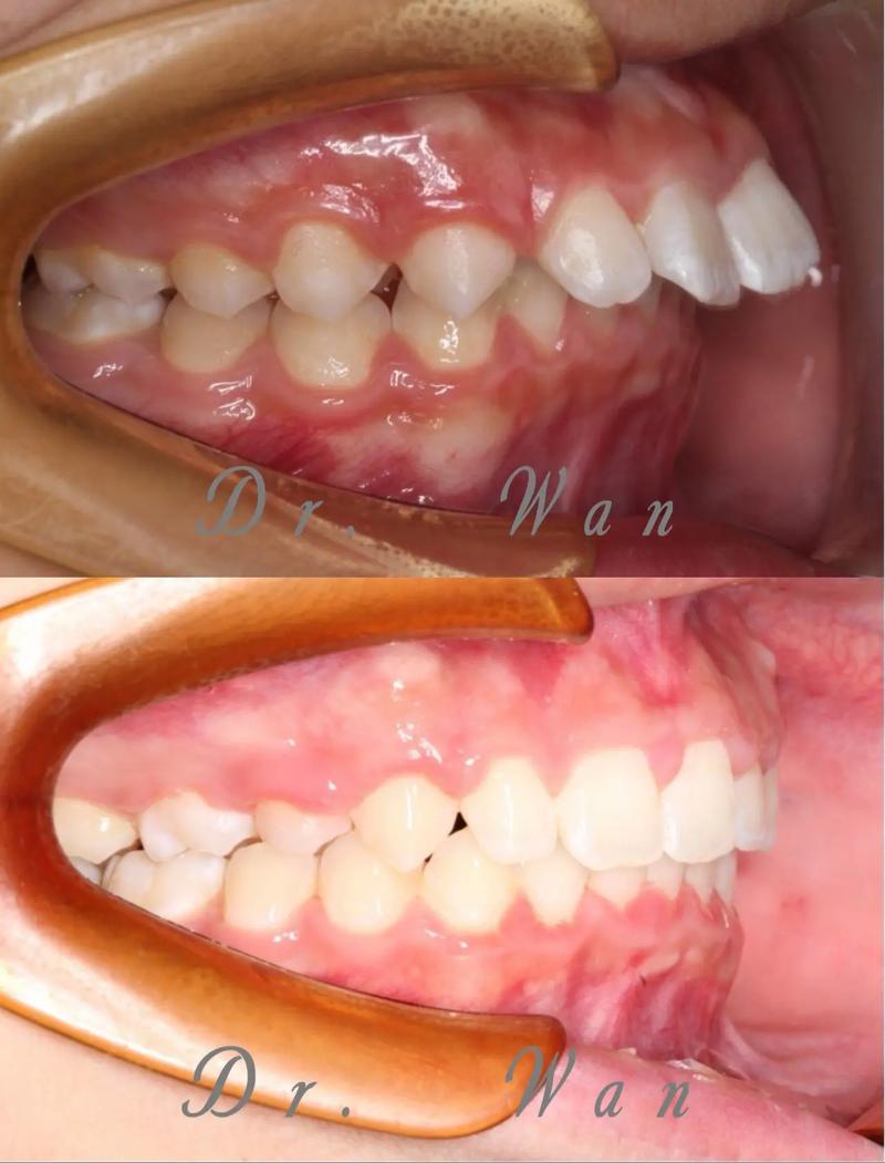 口腔正畸中覆盖具体指什么？-图2