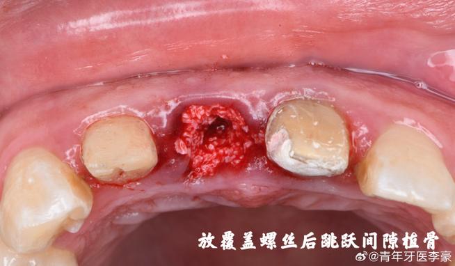种牙植骨后，肿胀一般会持续多长时间才完全消肿？-图3