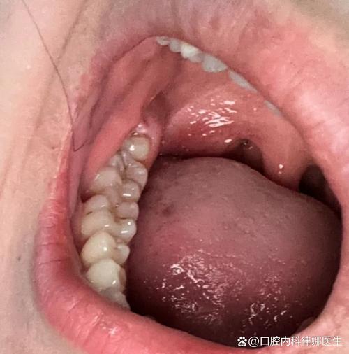 奥齿泰只植牙过敏-图1