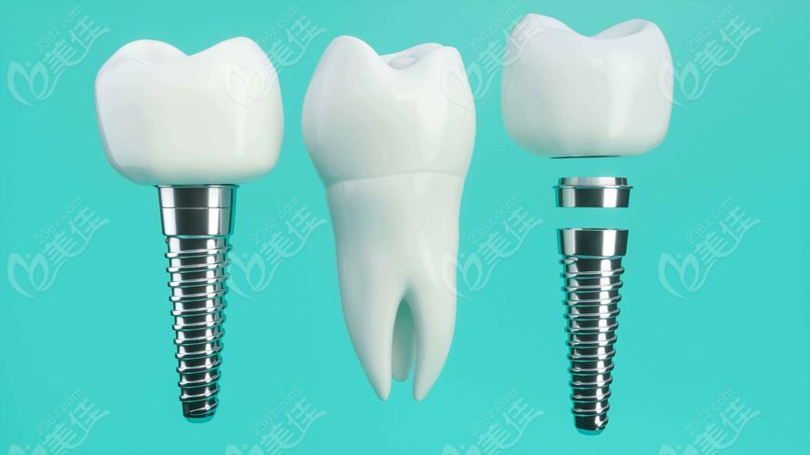 奥齿泰只植牙过敏-图2