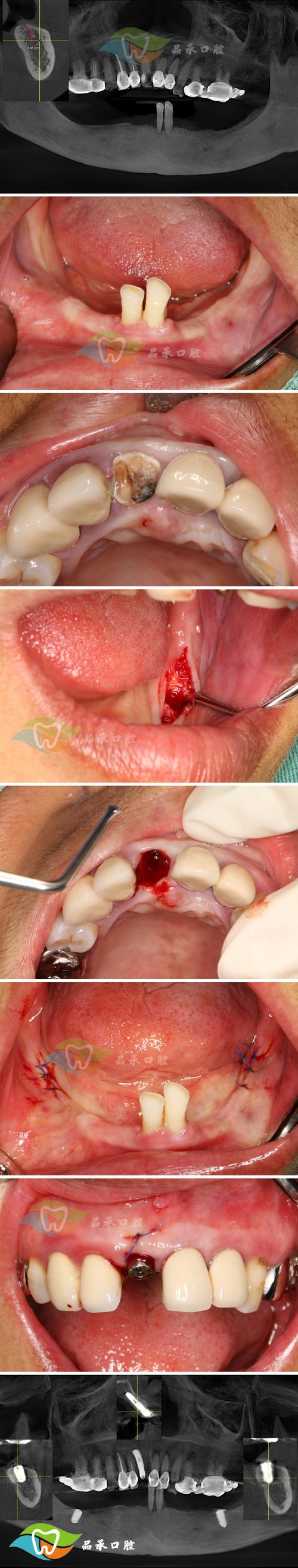 保定市二医院植牙效果如何？价格贵不贵？技术靠谱吗？-图3