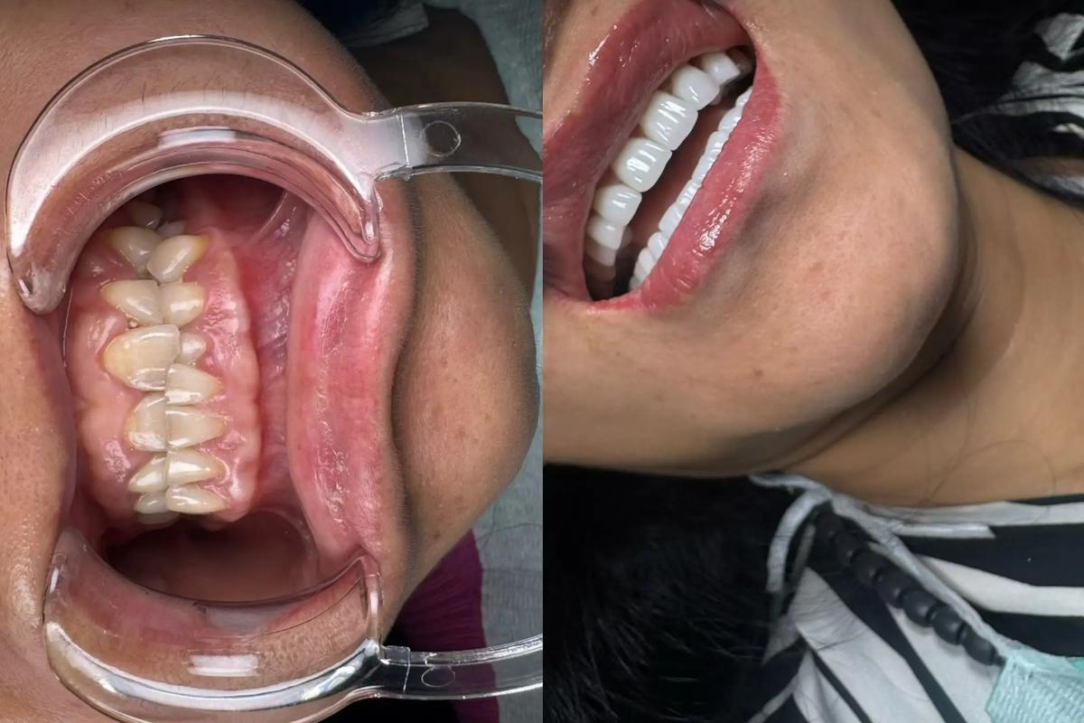 带全植牙会口臭吗-图1