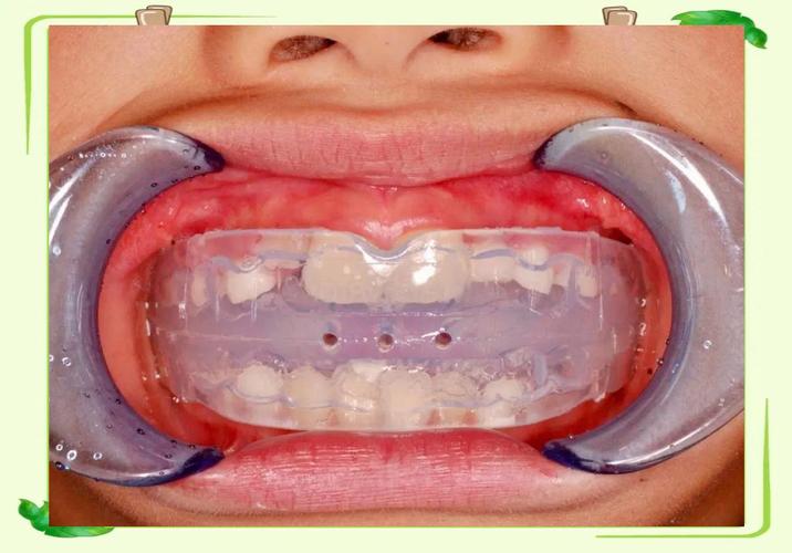 功能诱导与正畸治疗，如何选择早期矫治方案？-图1