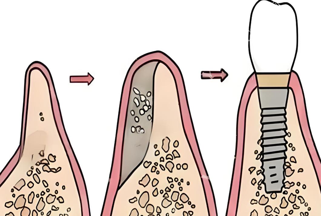 种植牙不需要植骨-图2