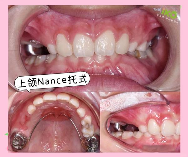 滑动法关闭正畸间隙-图1