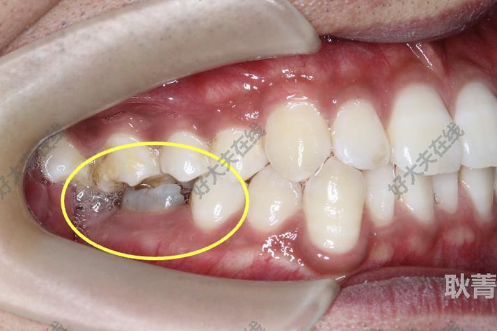 滑动法关闭正畸间隙-图2