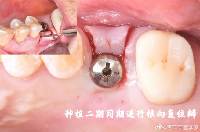 珠海公立医院植牙效果如何？价格贵不贵？靠谱吗？-图1