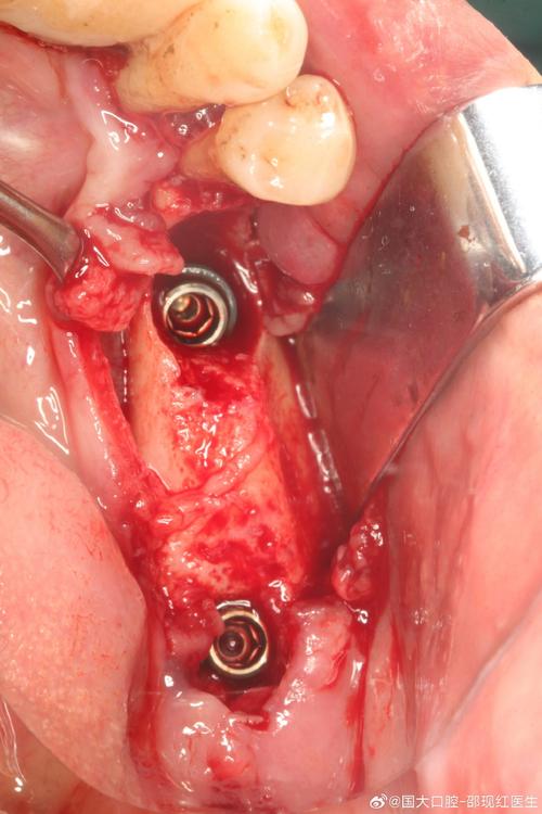 种植牙拔牙时植骨-图1