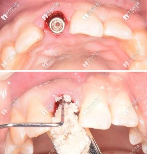 种牙植骨粉后照片-图2