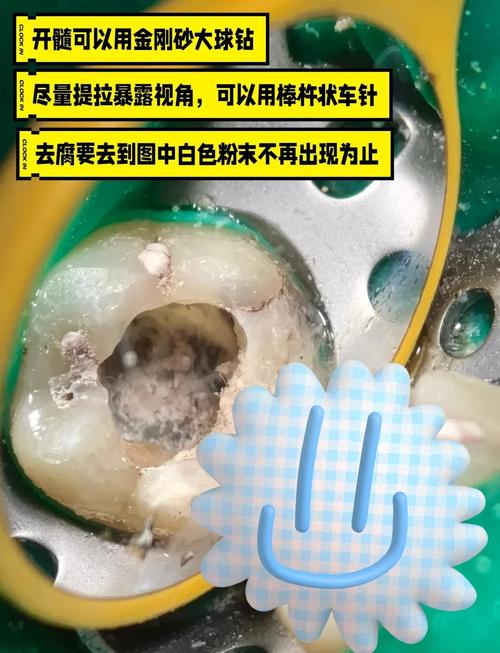 正畸牙根吸收的研究-图2 正畸牙根吸收的研究-图2