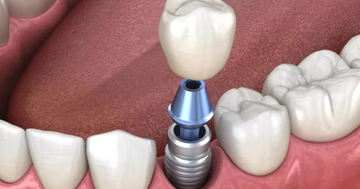 种植牙要植软组织-图1