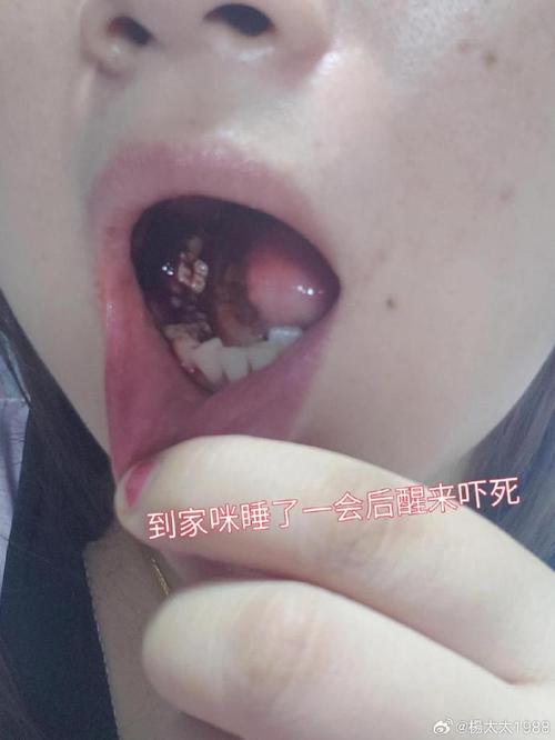 种牙植骨粉出来了-图2