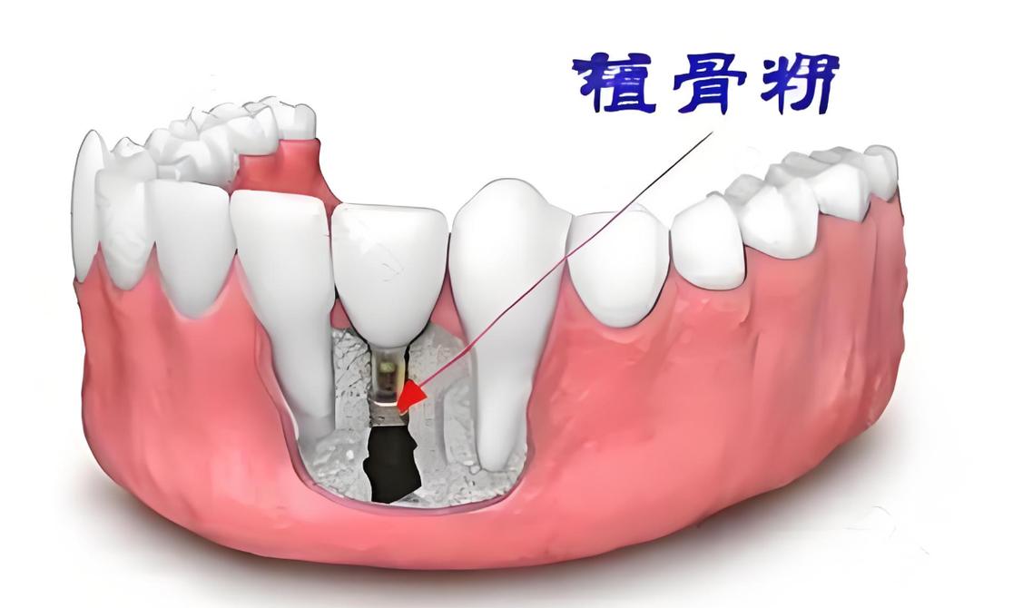 牙种植植骨是什么-图1