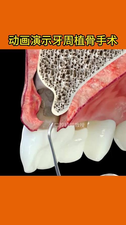 牙种植植骨是什么-图3