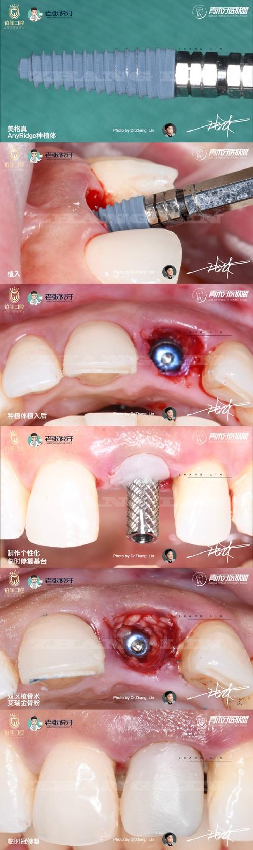 植骨的即刻种植牙，效果真的比传统种植更稳定吗？-图1