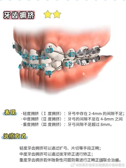 哪些类型的地包天可以通过正畸矫正？-图3