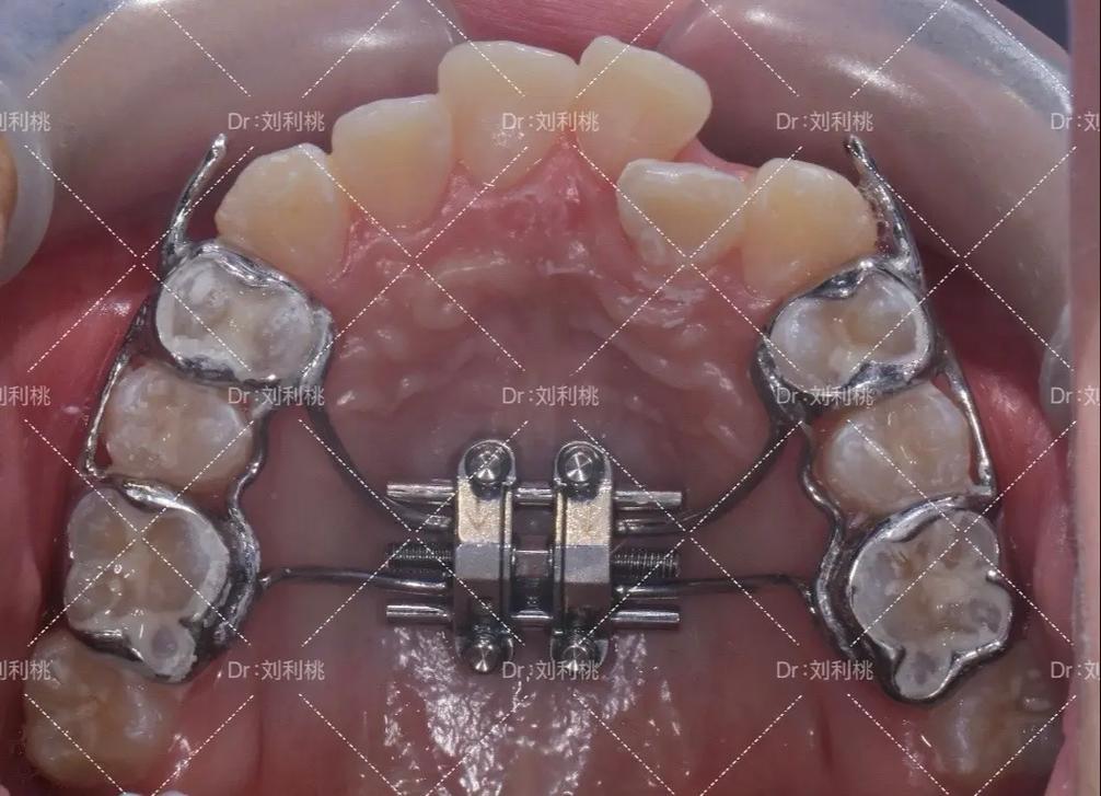 正畸刺激下颌骨生长-图1