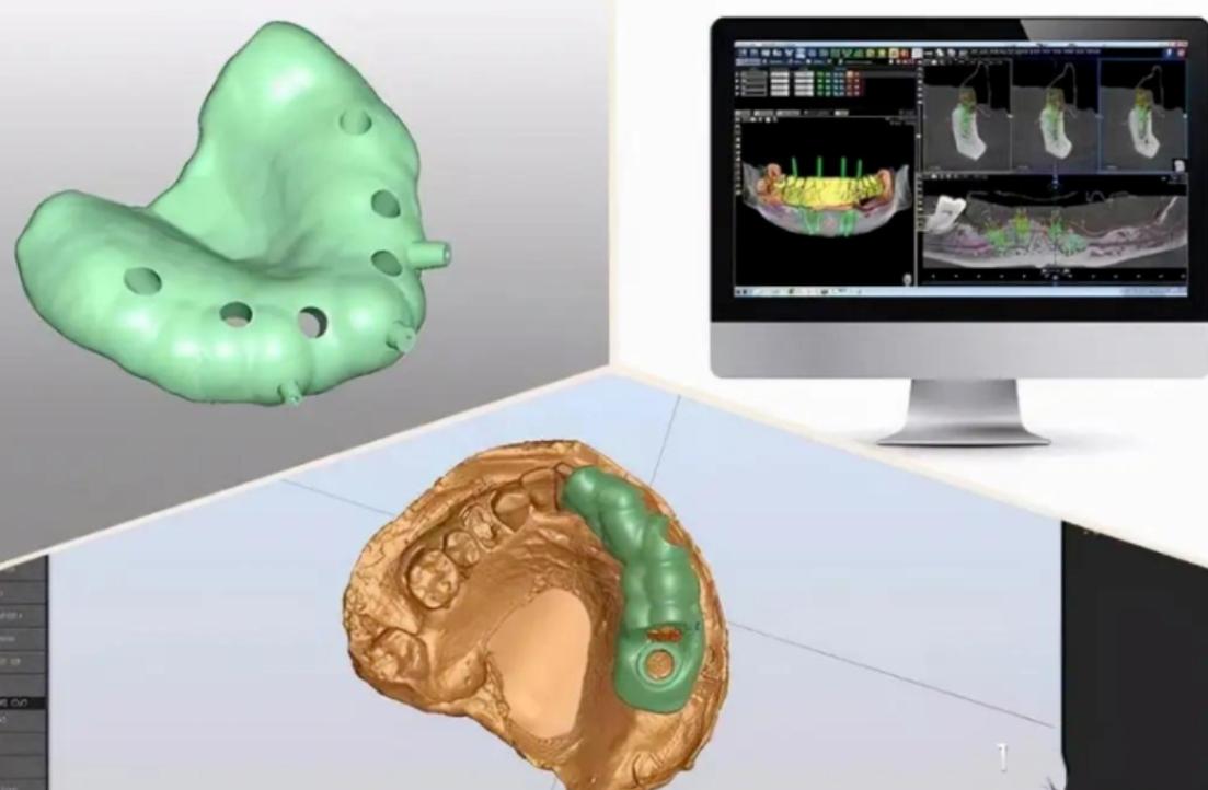 全数字话导航植牙-图2
