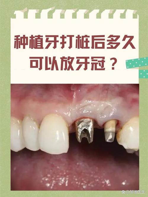 植牙多久可以装冠-图3 植牙多久可以装冠-图3