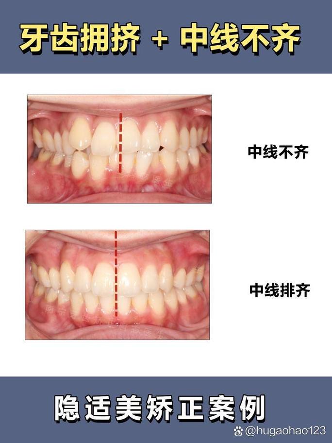 正畸 中线什么意思-图1
