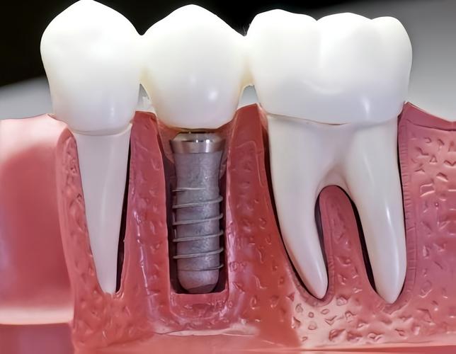 广东去哪里植牙好-图2