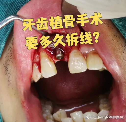 种植牙植骨后疼痛一般会持续几天？-图3
