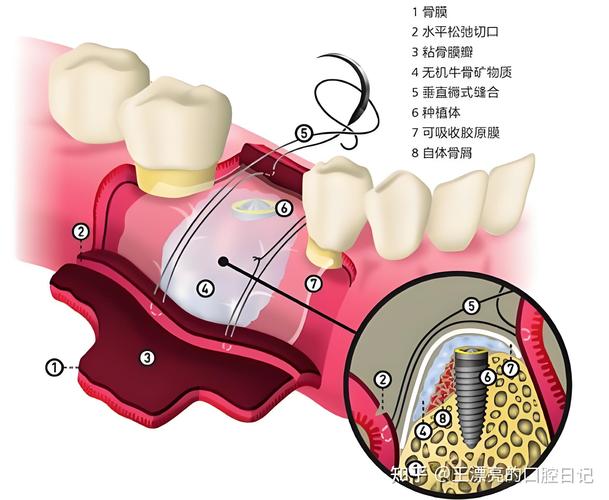 种植牙植骨后疼痛一般会持续几天？-图2
