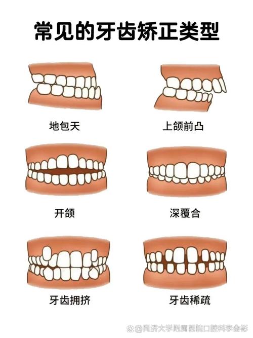 正畸过程问题及解决-图3 正畸过程问题及解决-图3