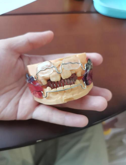 做正畸要用那些器材-图1