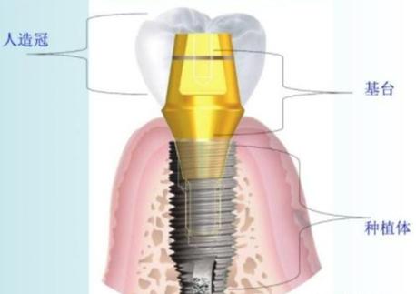 植牙 基台要钱吗-图1 植牙 基台要钱吗-图1