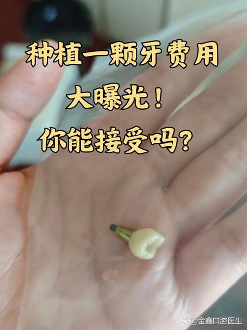 植牙 基台要钱吗-图2 植牙 基台要钱吗-图2